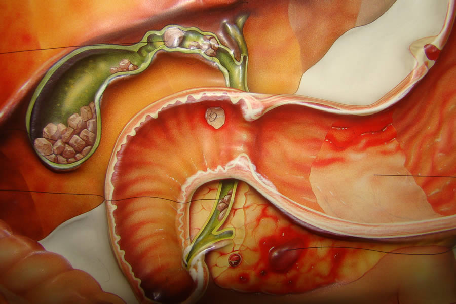 Esquema Biliopancreatico