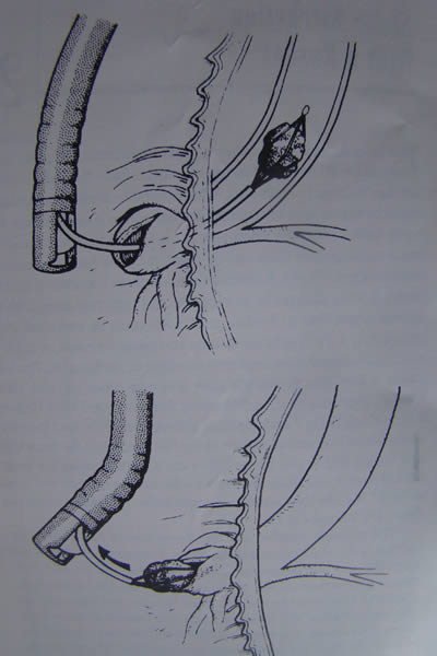 Extracción endoscopica de Calculos de coledoco
