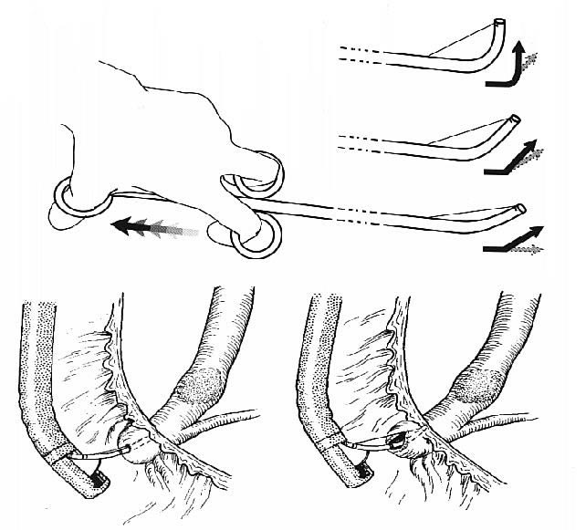 Papilotomia endoscopica