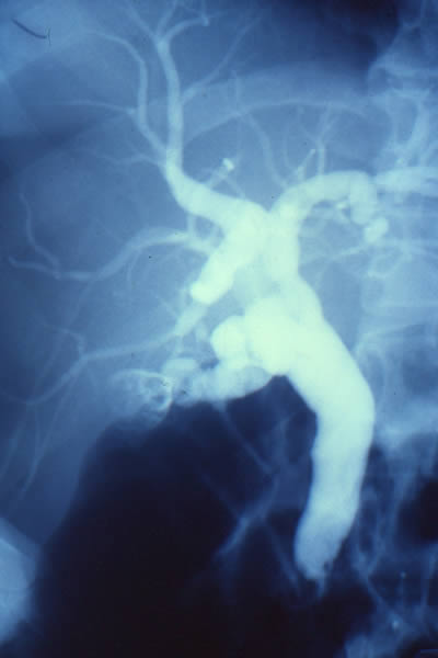 Colecistitis Crónica Cálculosa Atrófica