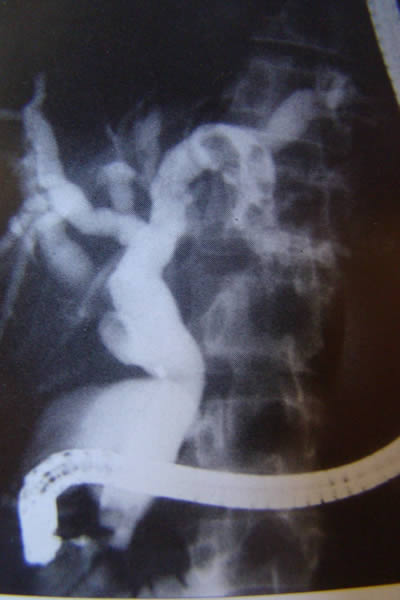 Litiasis intra-hepatica de conducto hepatico izquierdo