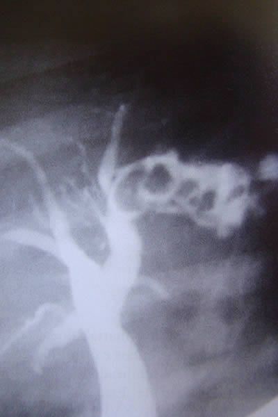 Calculos intrahepaticos multiples en conducto secundario izquierdo