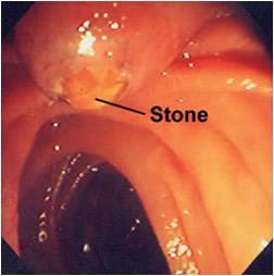 Coledocolitiasis impactada en ostium papila duodenal mayor, paciente con pancreatitis biliar aguda