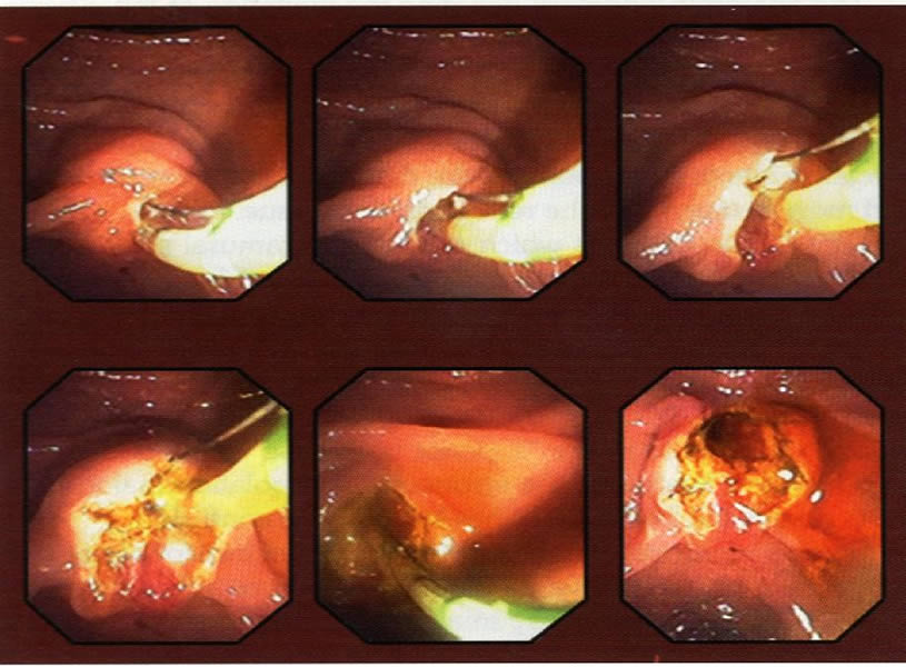 Papilotomia endoscopica