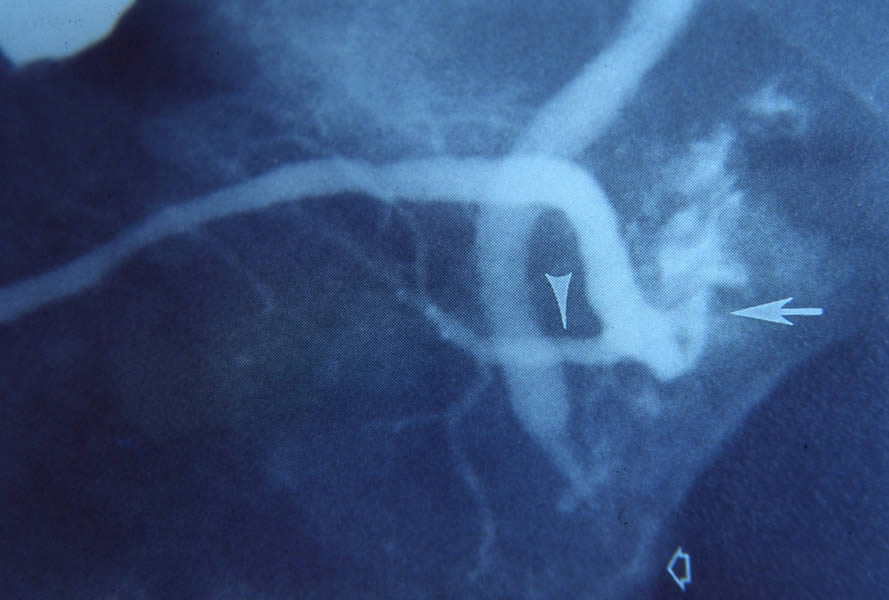 Pancreas divisum