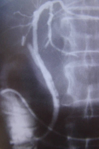 Estenosis completa de conducto hepatico derecho por clipaje quirurgico