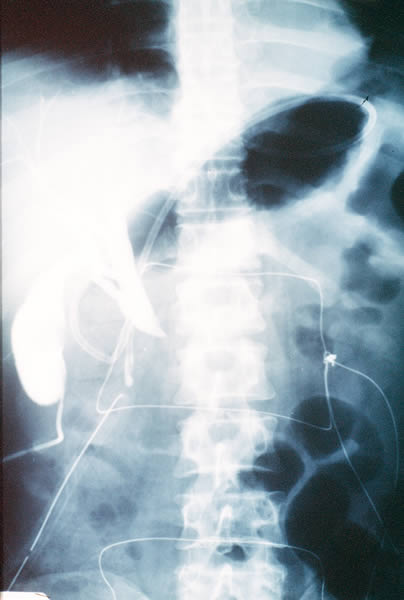 Pancreas divisum
