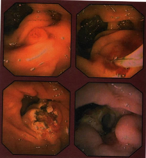 Papilotomia endoscopica