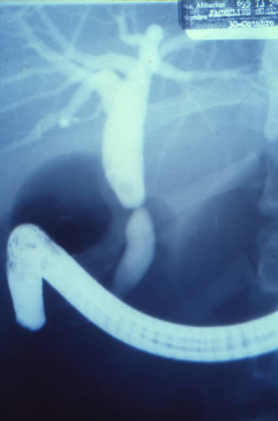 Estenosis anular post-quirurgica de tercio medio de coledoco