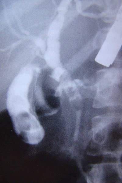 Calculos en vesicula biliar y coledocolitiasis multiple con estrechez relativa en tercio distal por pancreatitis Crónica.