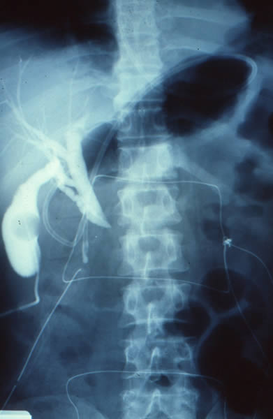 Pancreas divisum
