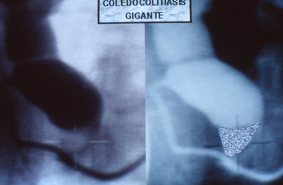 Coledocolitisis gigante Unica y digitaslizacion de misma imagen