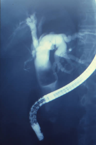 Coledoclitiasis Gigante