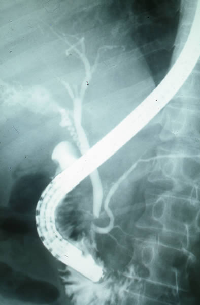 Colangio pancreatografia Endoscopica Retrograda: Calculos multiples en vesicula biliar.