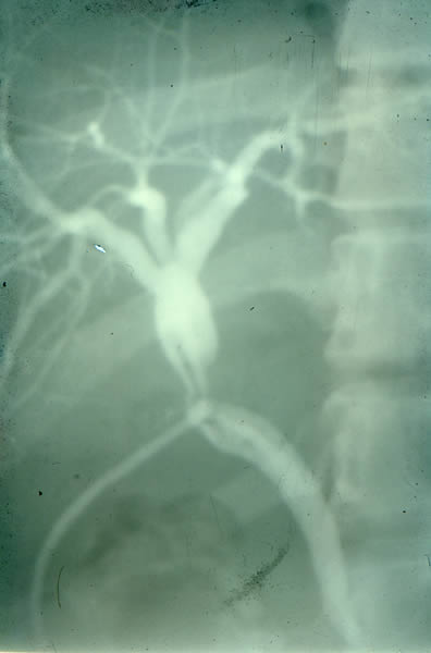 Estenosis de coledocotomia con sonda en “T” in situ.