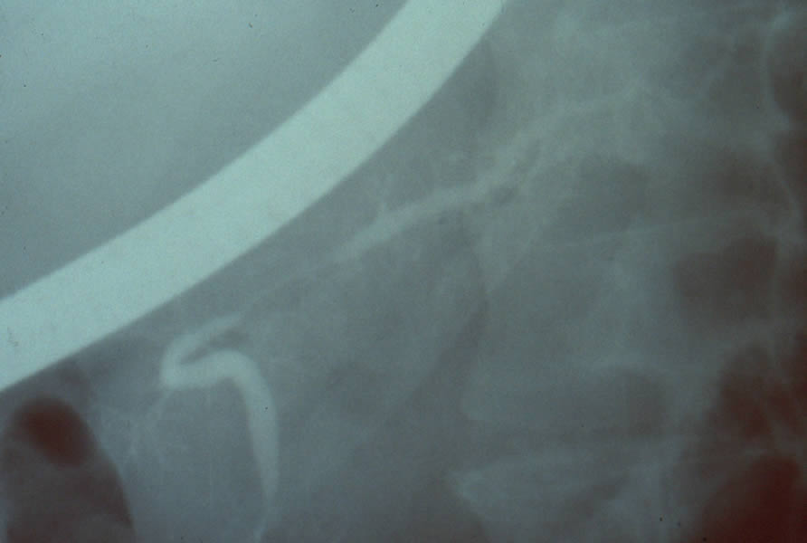 Estenosis conducto pancreático entre cabeza y cuerpo