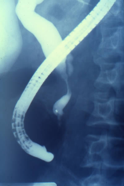 Estenosis tercio distal de colédoco por Neoplasia pancreática.
