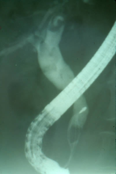 Coledocolitiasis multiple