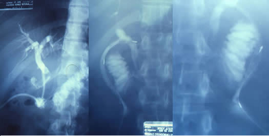 Extraccion de coledocolitiasis por trayecto de sonda en T