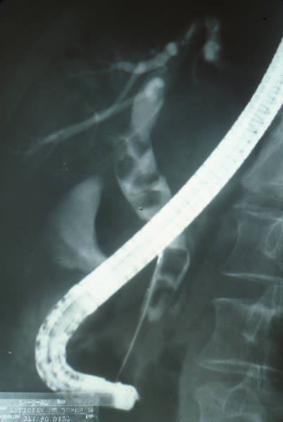Coledocolitiasis multiple