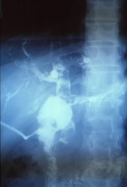 Coledocolitiasis multiple residual, con sonda en “T” y fuga biliar por coledotomia.