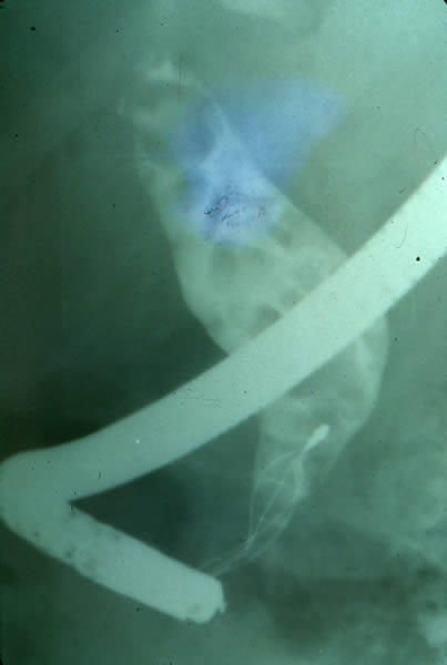 Coledocolitiasis múltiple gigante, momento de extracción con canastilla de Dormia.