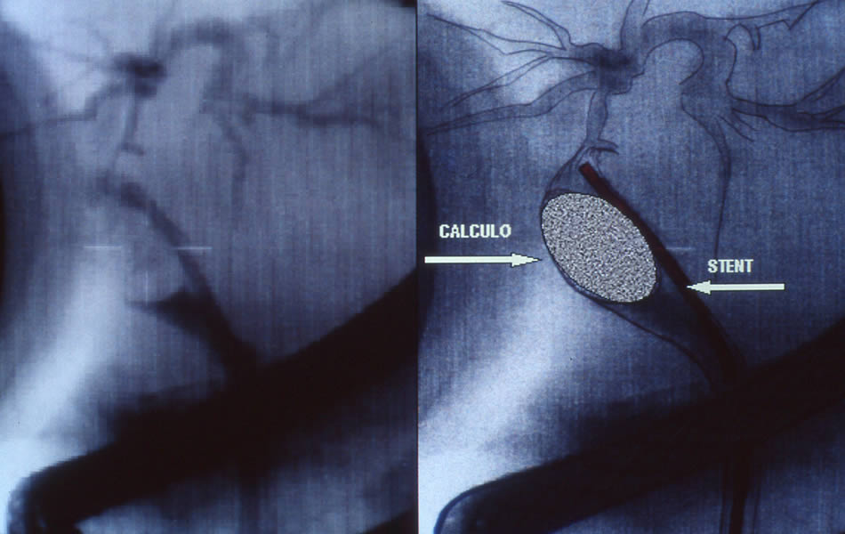 Coledocolitiasis gigante mas stent biliar paliativo con imagen digitalizada