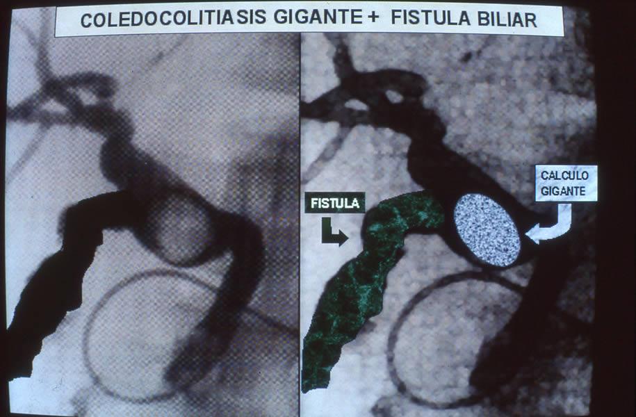 Colédocolitiasis única gigante mas fistula biliar de alto gasto.