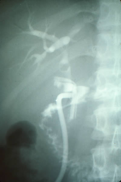 Exploración de vías biliares con tubo en “T” mal posicionado y coledoclitiasis proximal.