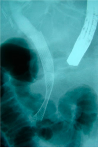 stent biliar autoexpansible (vision RX)