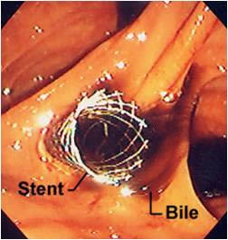 stent biliar autoexpansible (vision endoscopica)